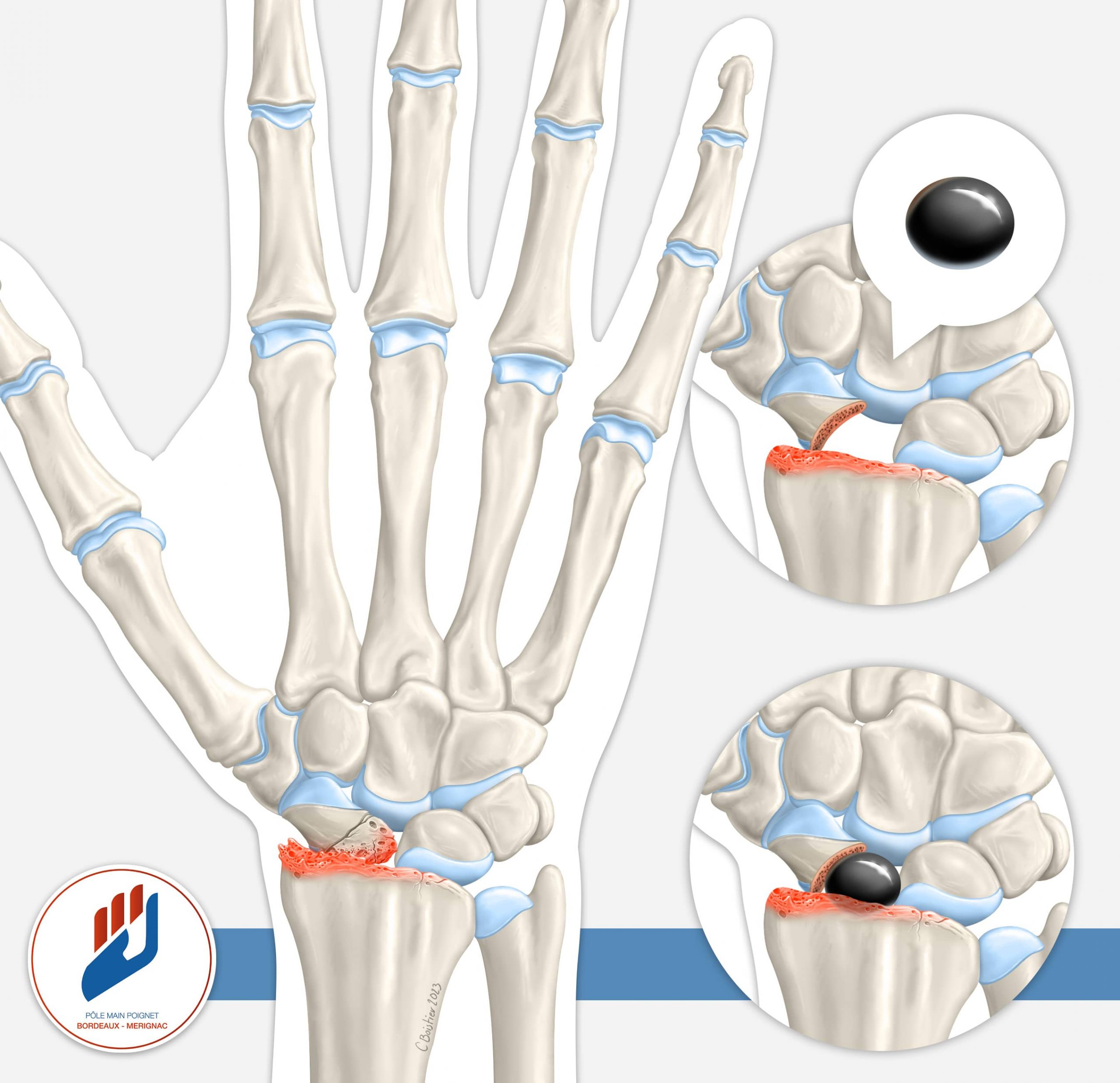 Arthrose du poignet à Bordeaux | Chirurgie de la main & du poignet