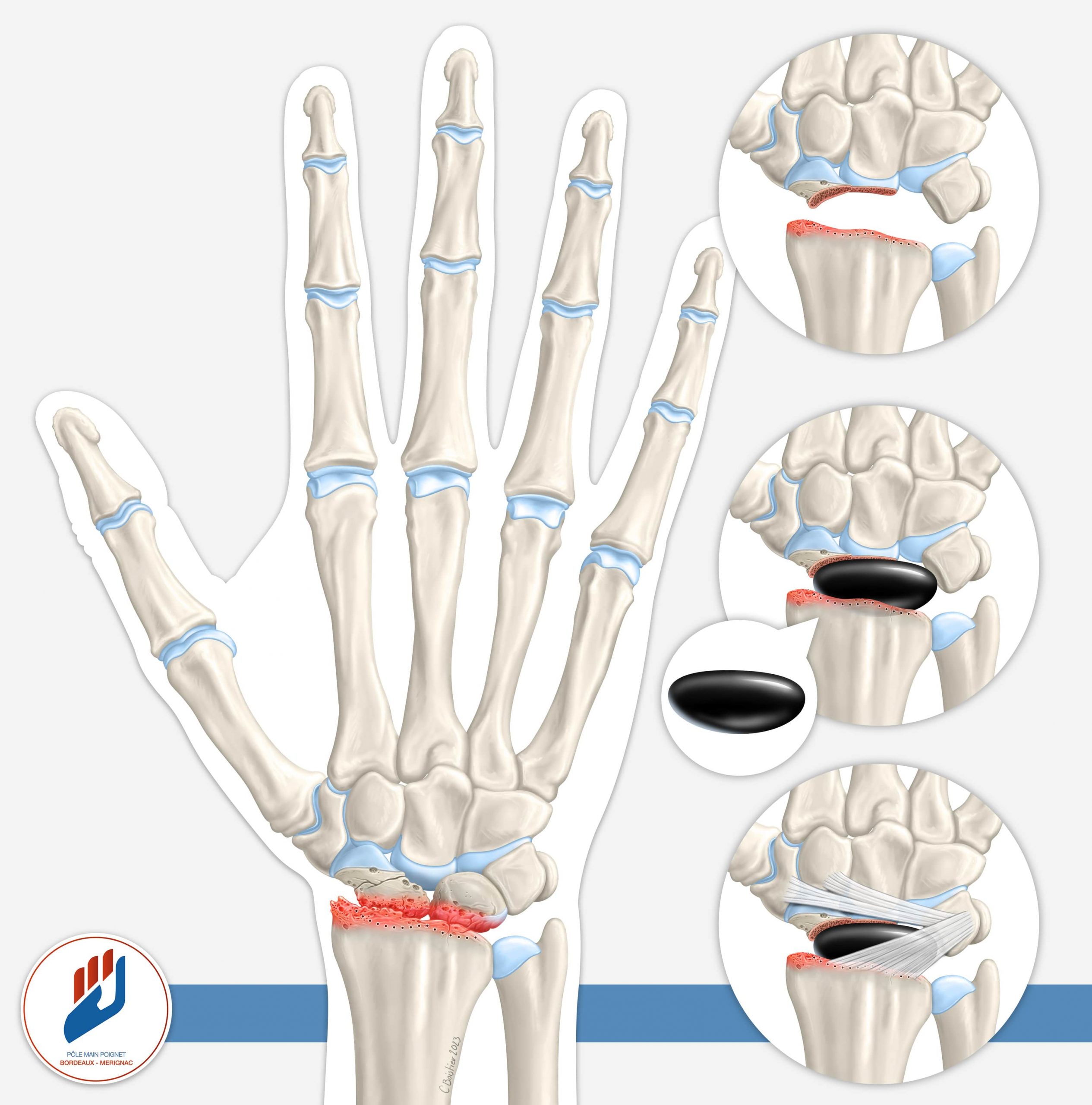 Arthrose du poignet à Bordeaux  Chirurgie de la main & du poignet